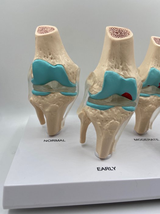 Uddannelses-/demonstrationsmodel - knæsygdom anatomisk model - 1990-2000