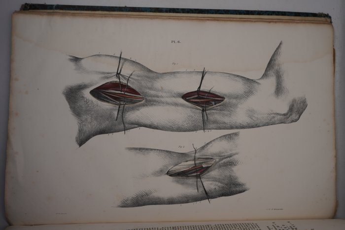 P J Manec - Traite theorique et pratique de la ligature des arteres [13 colour plates] - 1836