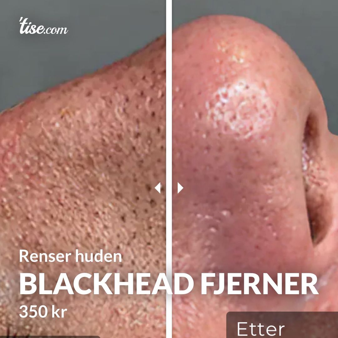 BLACKHEAD FJERNER