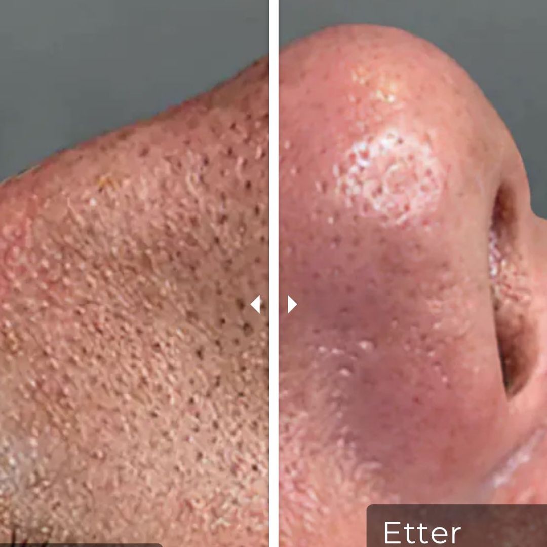 BLACKHEAD FJERNER